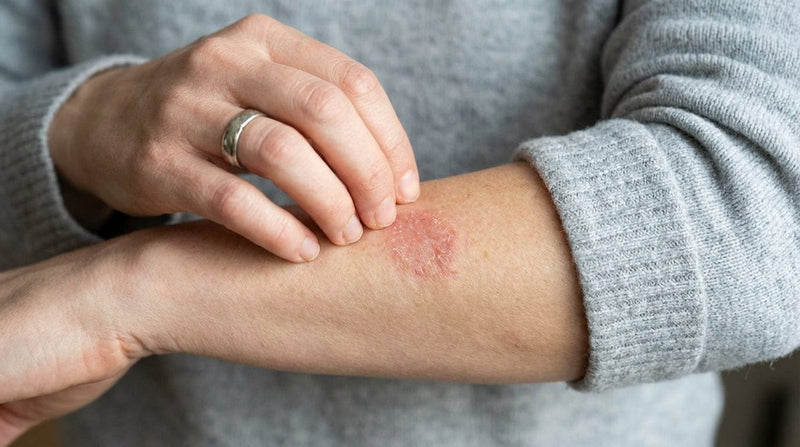 Why Does Eczema Keep Coming Back? How To Break The Itch Cycle Naturally