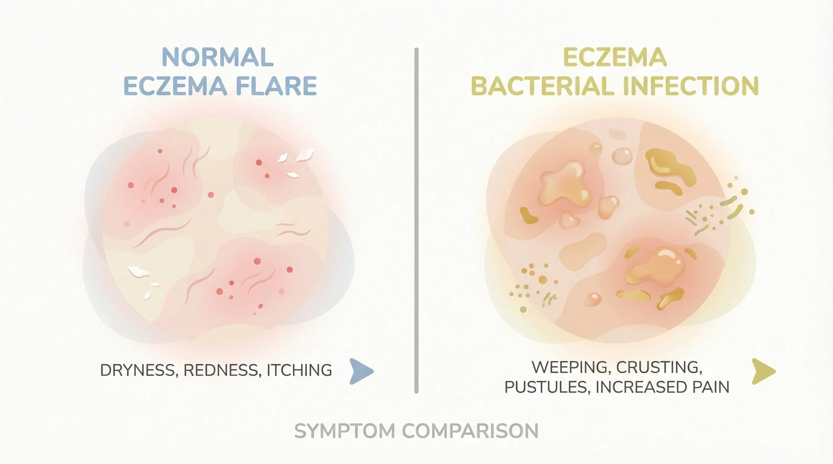 Eczema Bacterial Infection Symptoms: When to Act and What to Look For ...